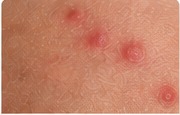 Realistic example of skin irritation that can resemble bed bug bites